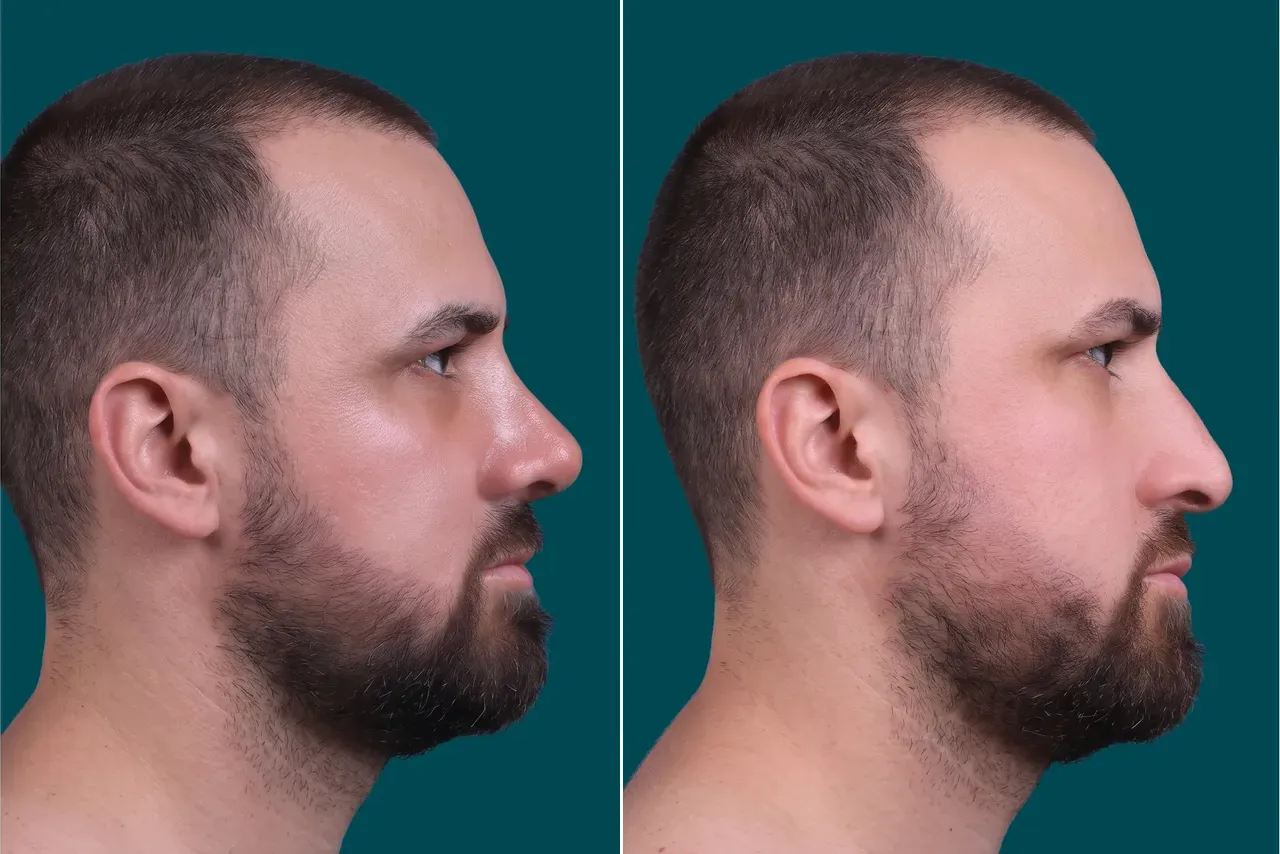 Rhinoplasty Before and After 7