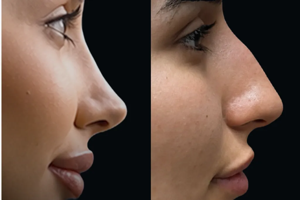 تجميل الأنف للنساء