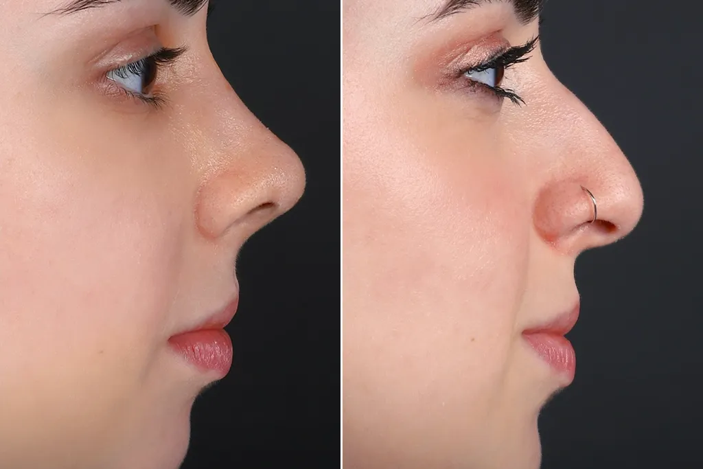 Rhinoplasty Before After In Turkey 8 (1)