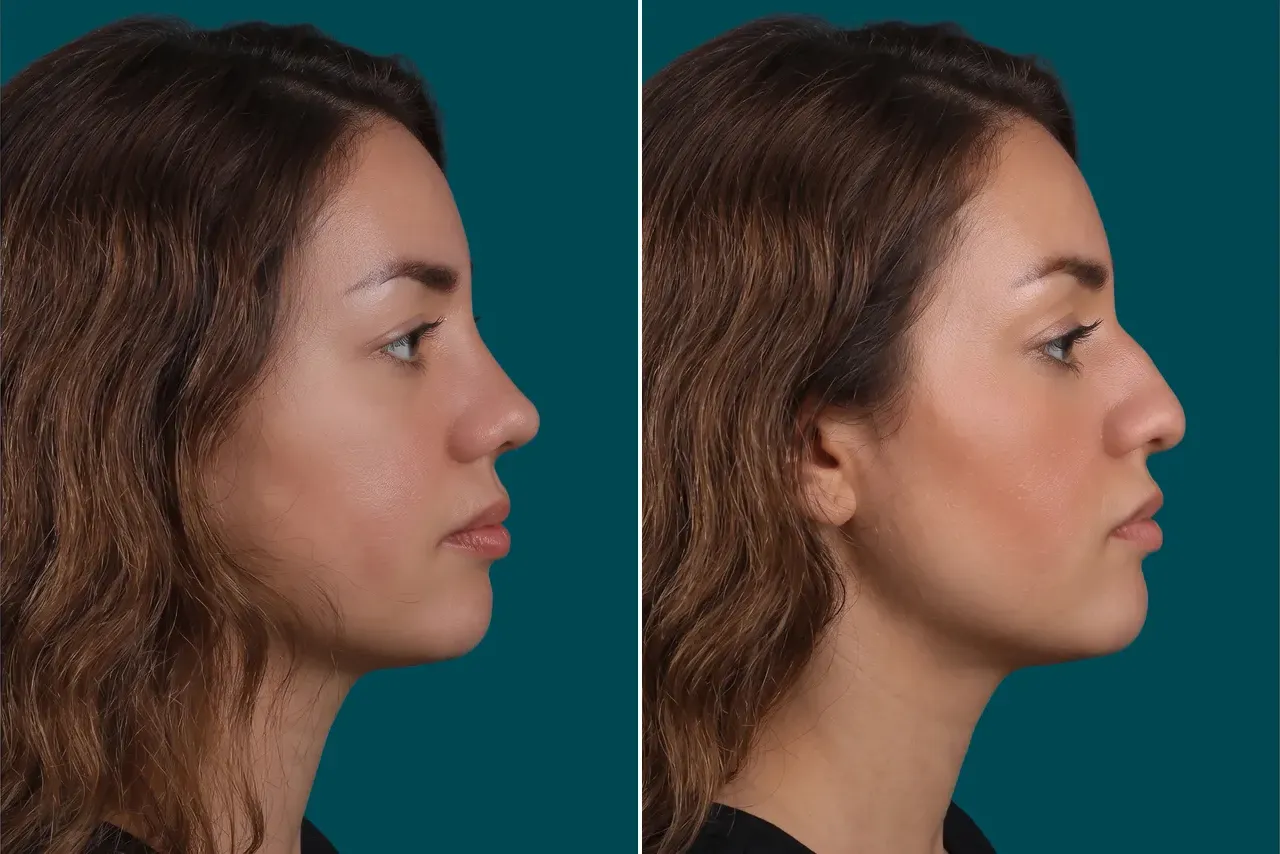 Rhinoplasty Before and After 8