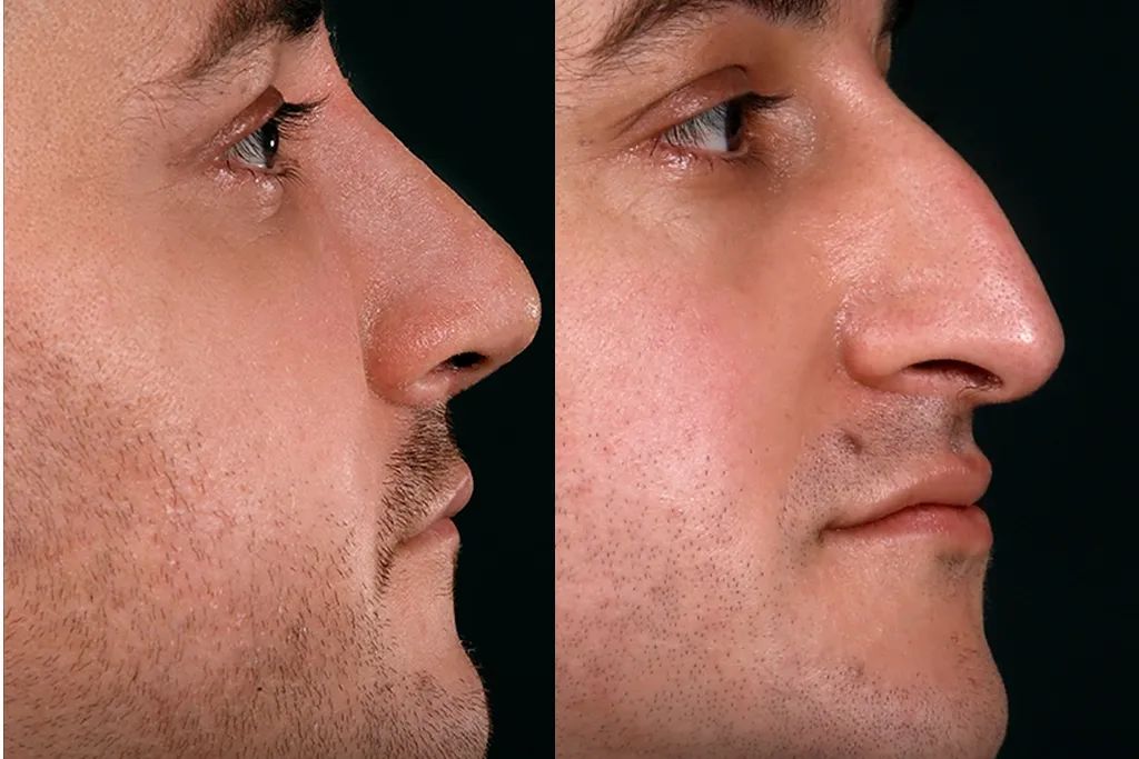 Rhinoplasty Before After In Turkey 9 (2)