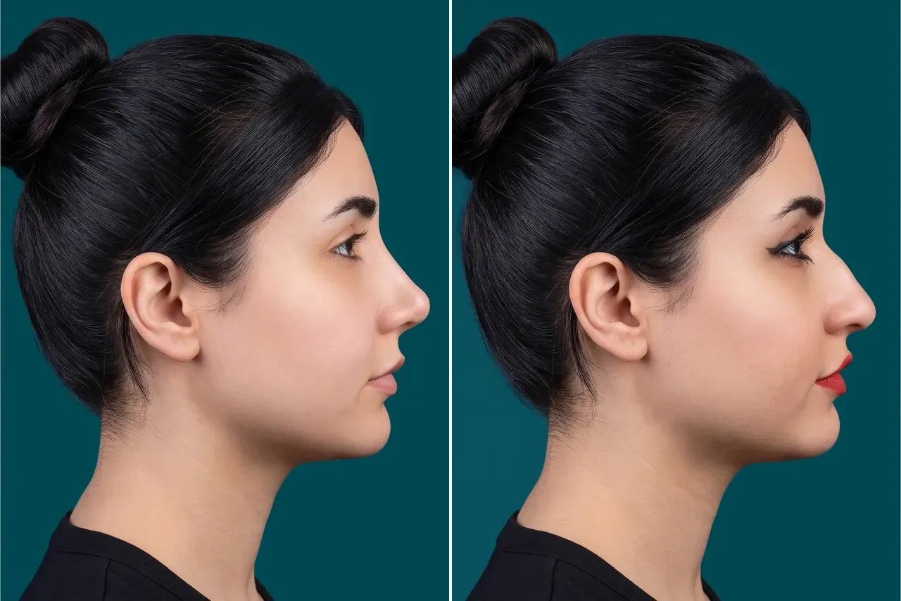 Rhinoplasty Before and After 9