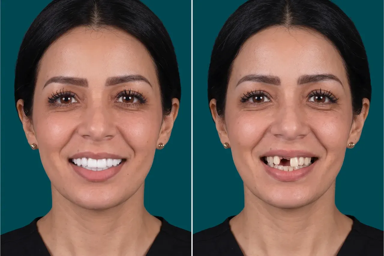 Dental Implants-Single Dental Implant 1