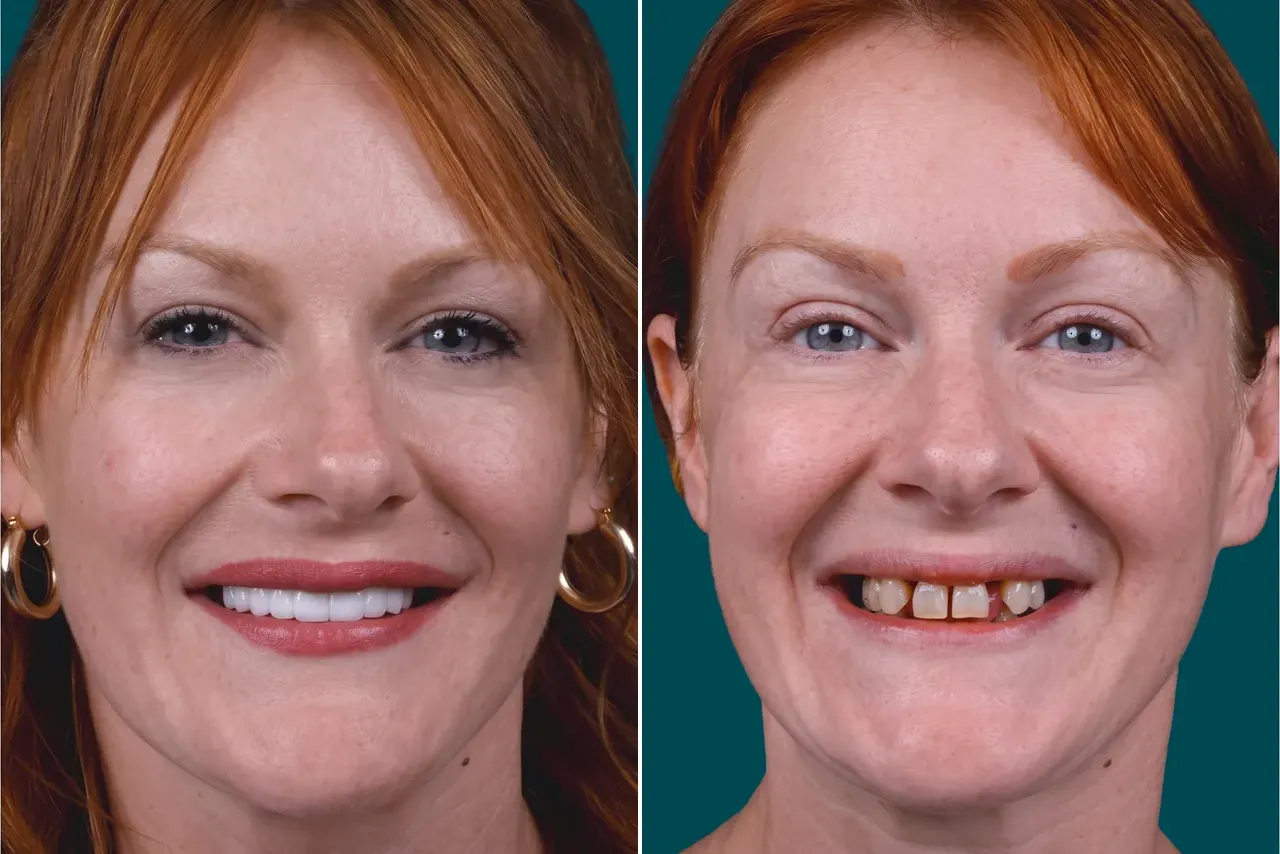 Dental Treatments-Single Dental Implant 