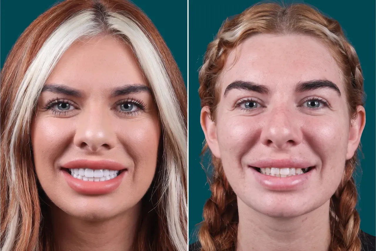 Dental Implants-Single Dental Implant 3
