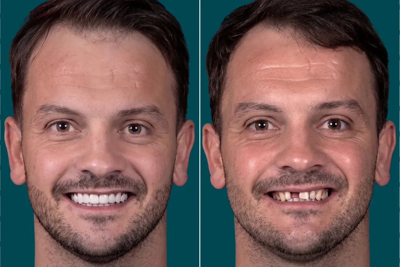 Dental Implants-Single Dental Implant 4