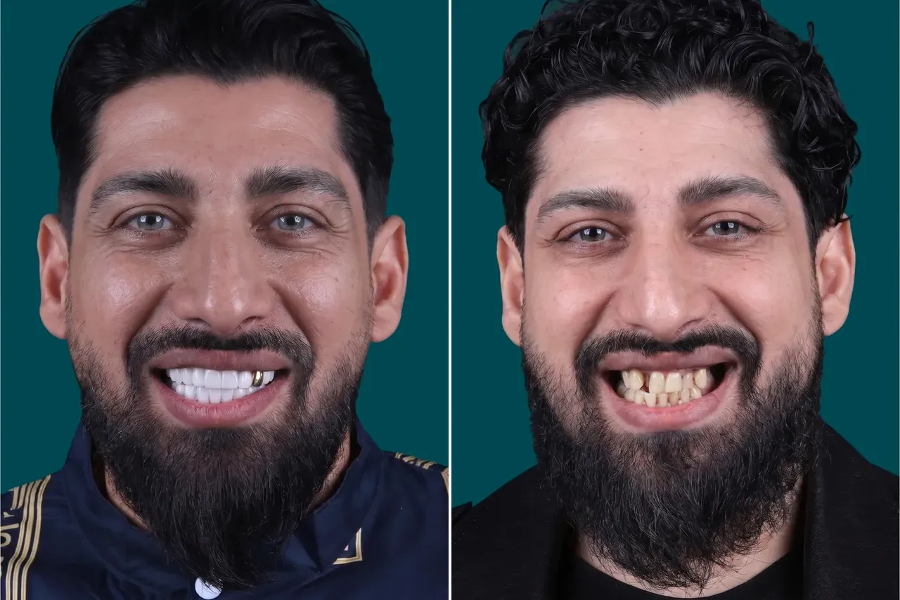 Smile-Makeover 1