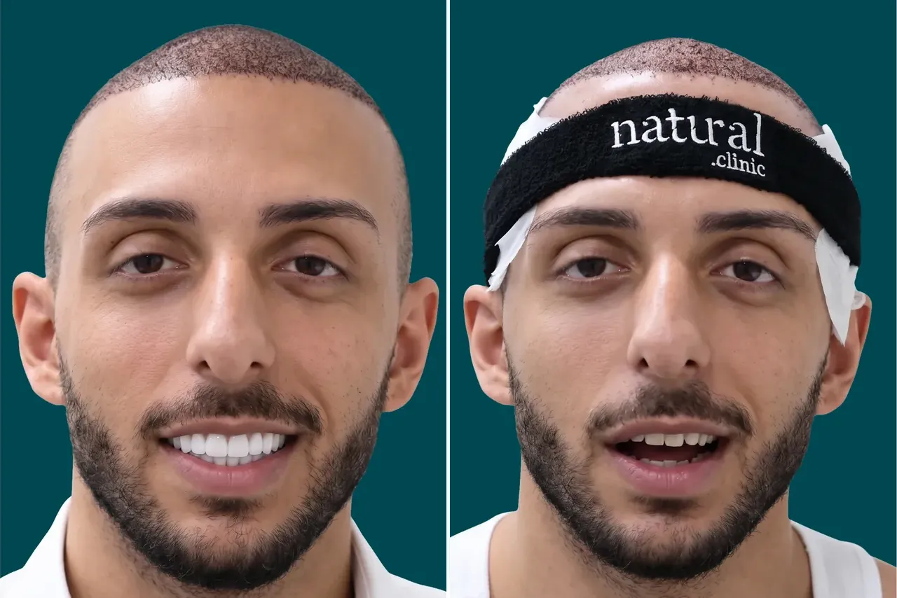Teeth-Whitening 1
