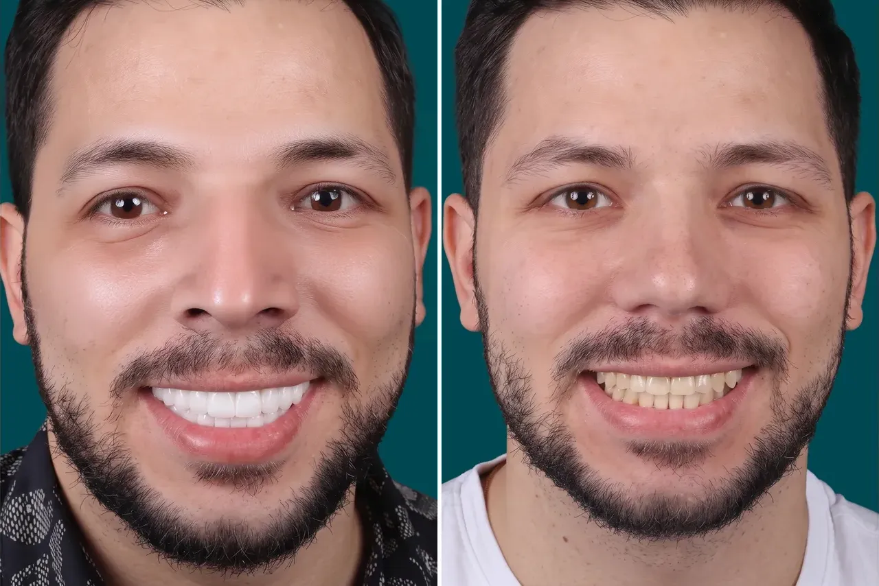 Teeth-Whitening 2