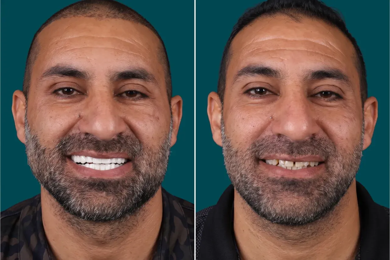Teeth-Whitening 3