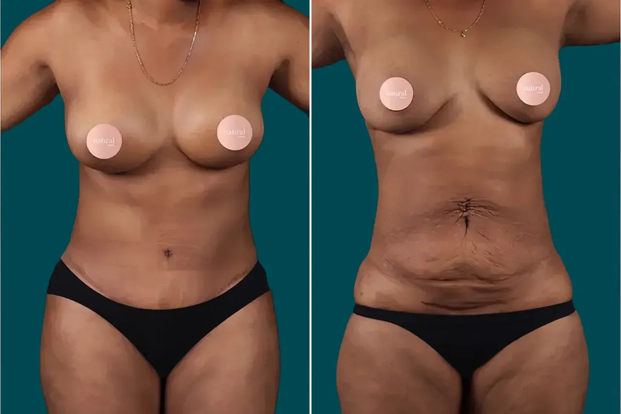 Tummy Tuck Before and After 1
