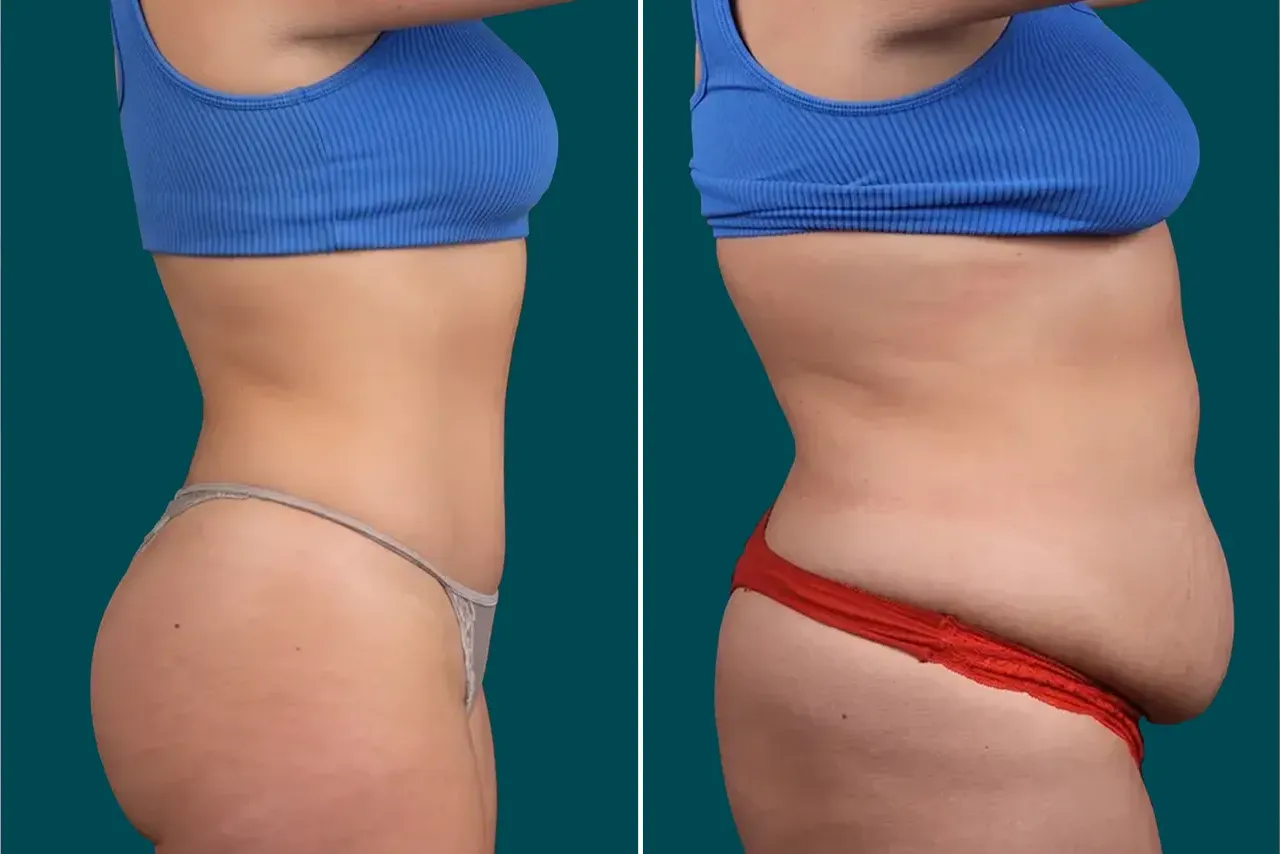 Tummy Tuck Before and After 2