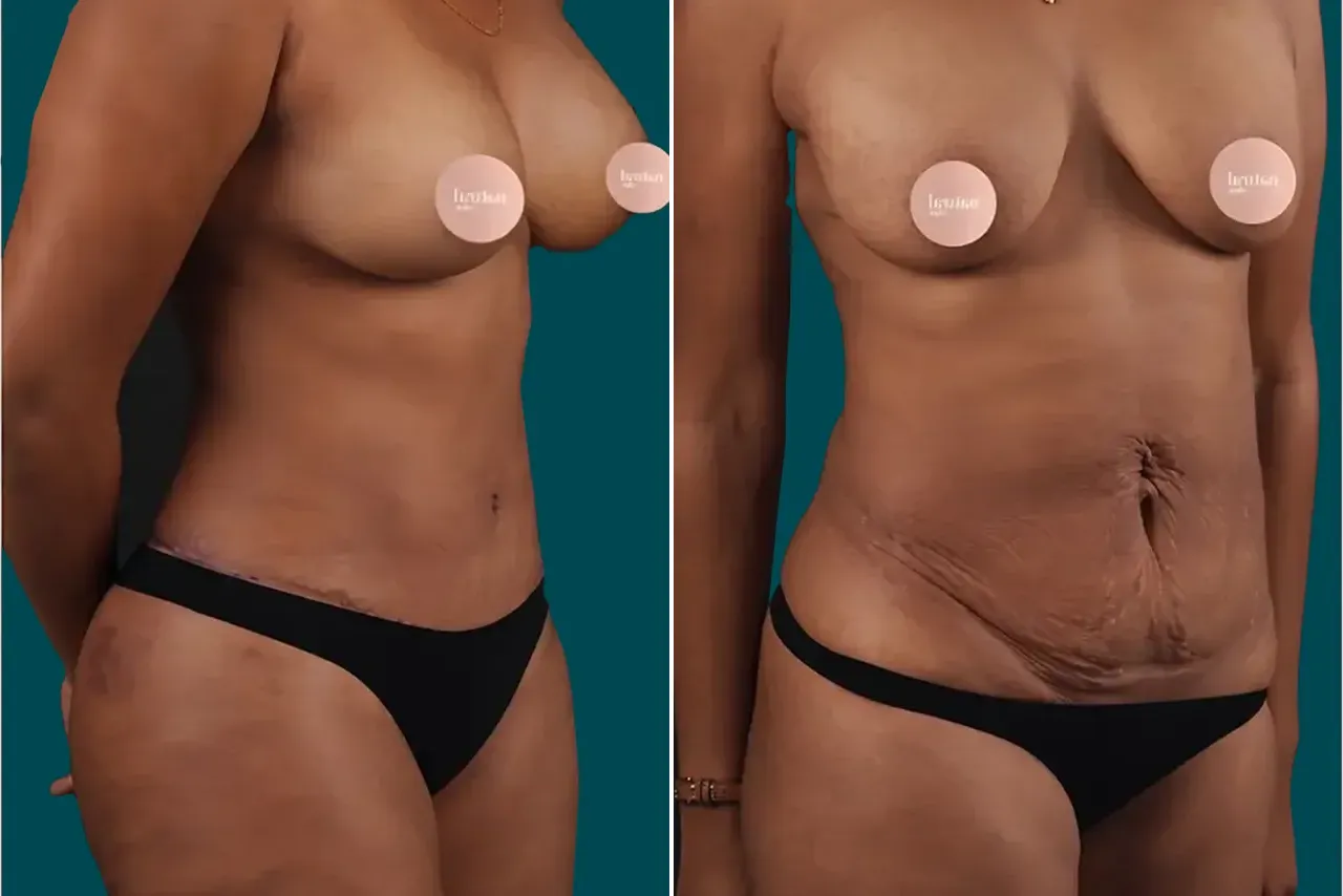 Tummy Tuck Before and After 3