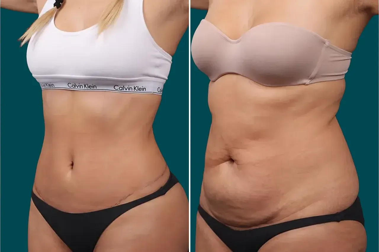 Tummy Tuck Before and After 5