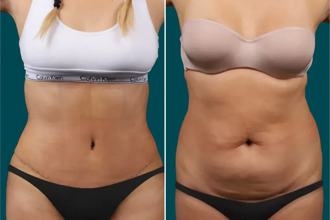 Tummy Tuck Before and After 4