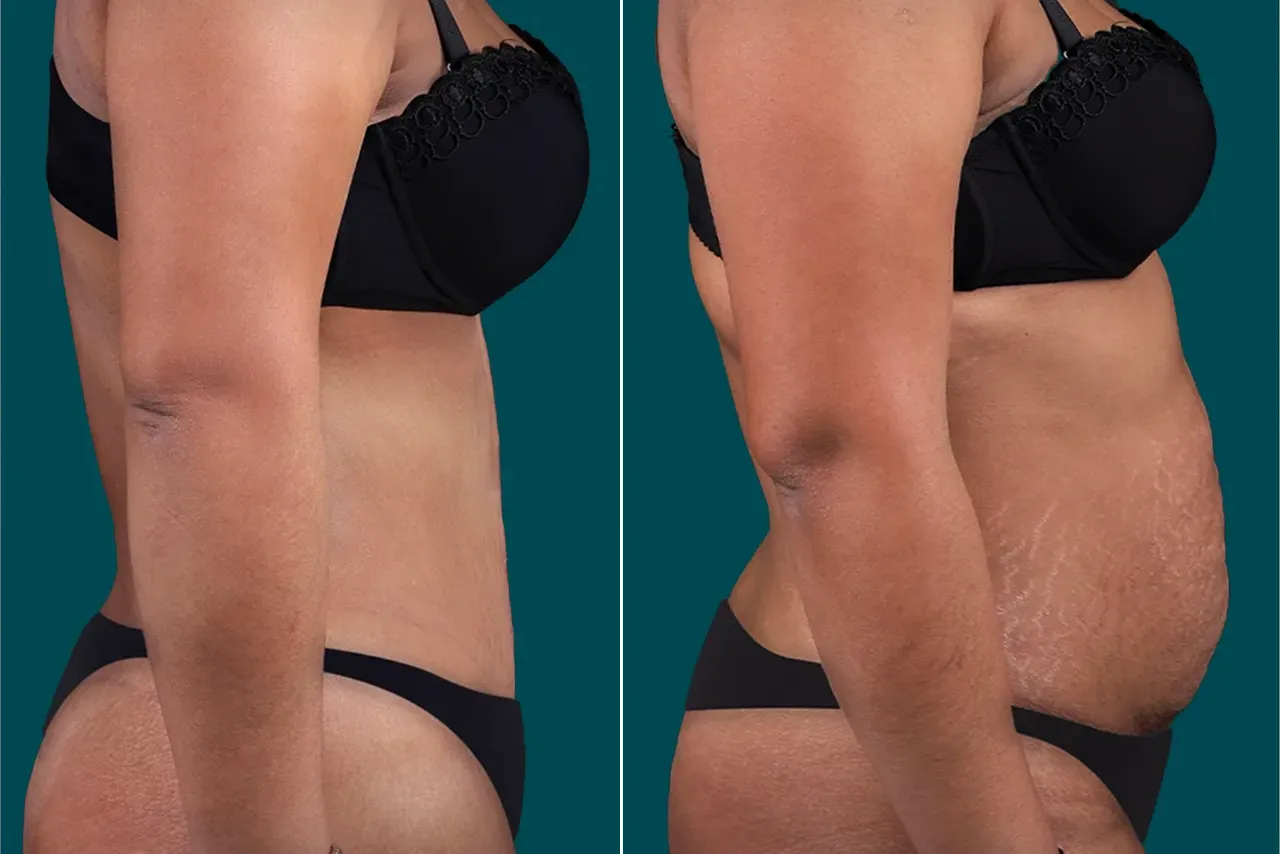 Tummy Tuck Before and After 6