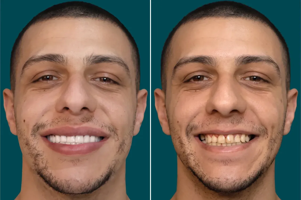 Dental-Crowns-Zirconia Crowns 1