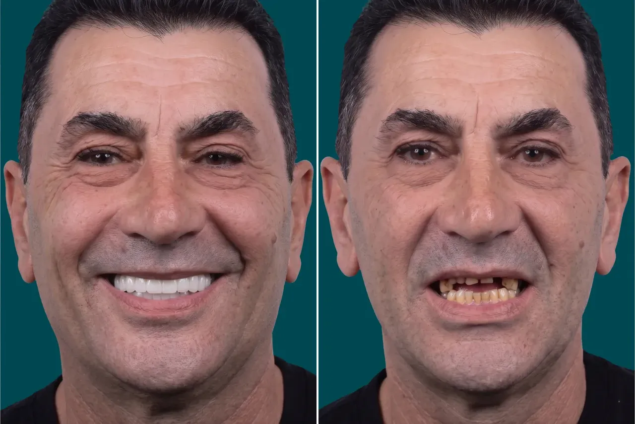 Dental Implants-Zygomatic Implants