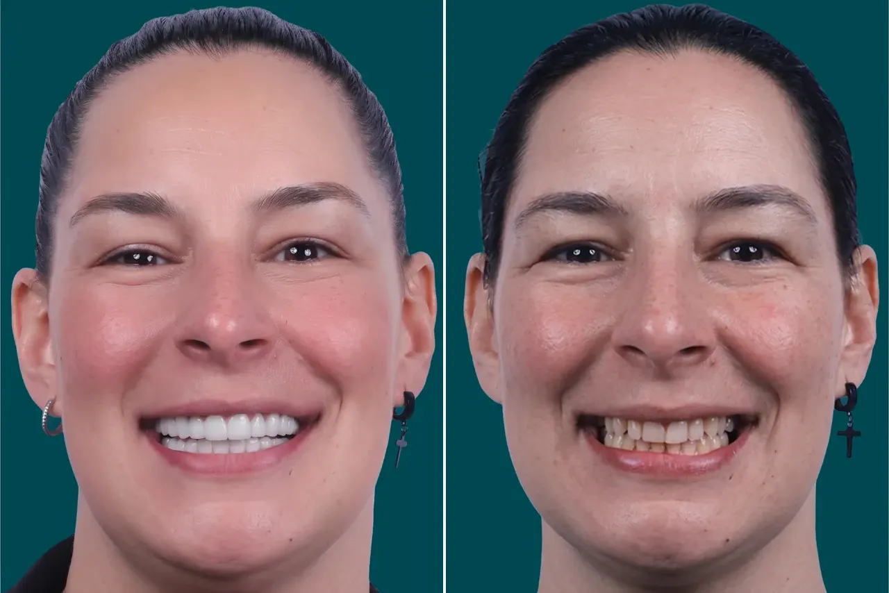 Dental Veneers 7