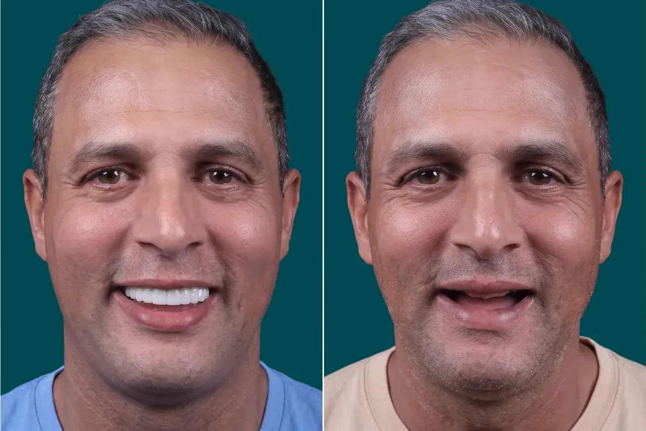 Dental Implants-Zygomatic Implants 3