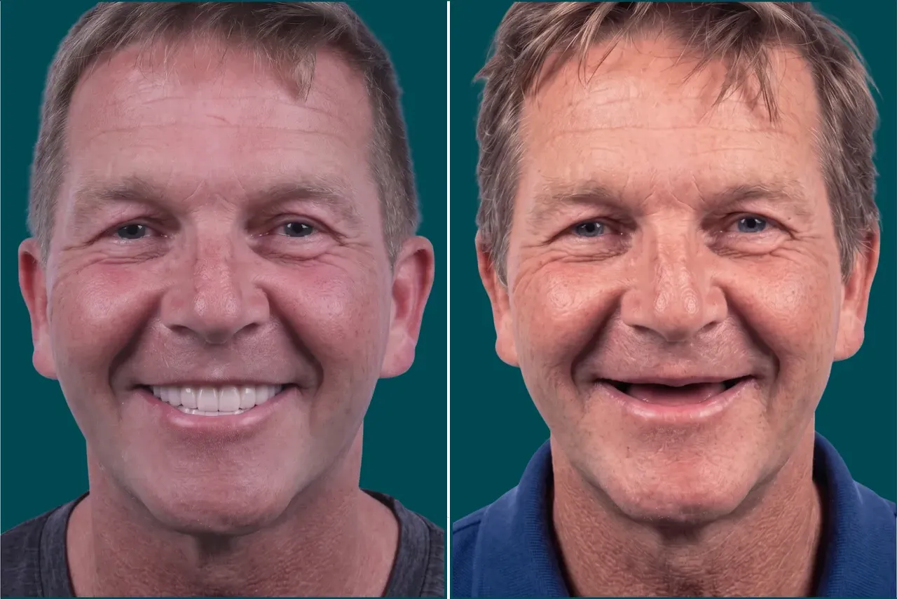 Dental Implants-Zygomatic Implants (1)