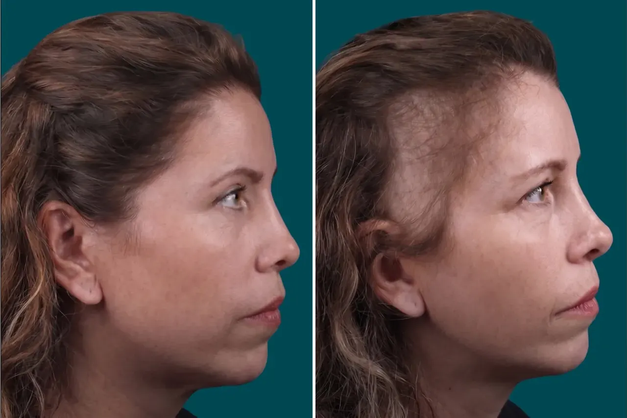 Female Hair Transplant
