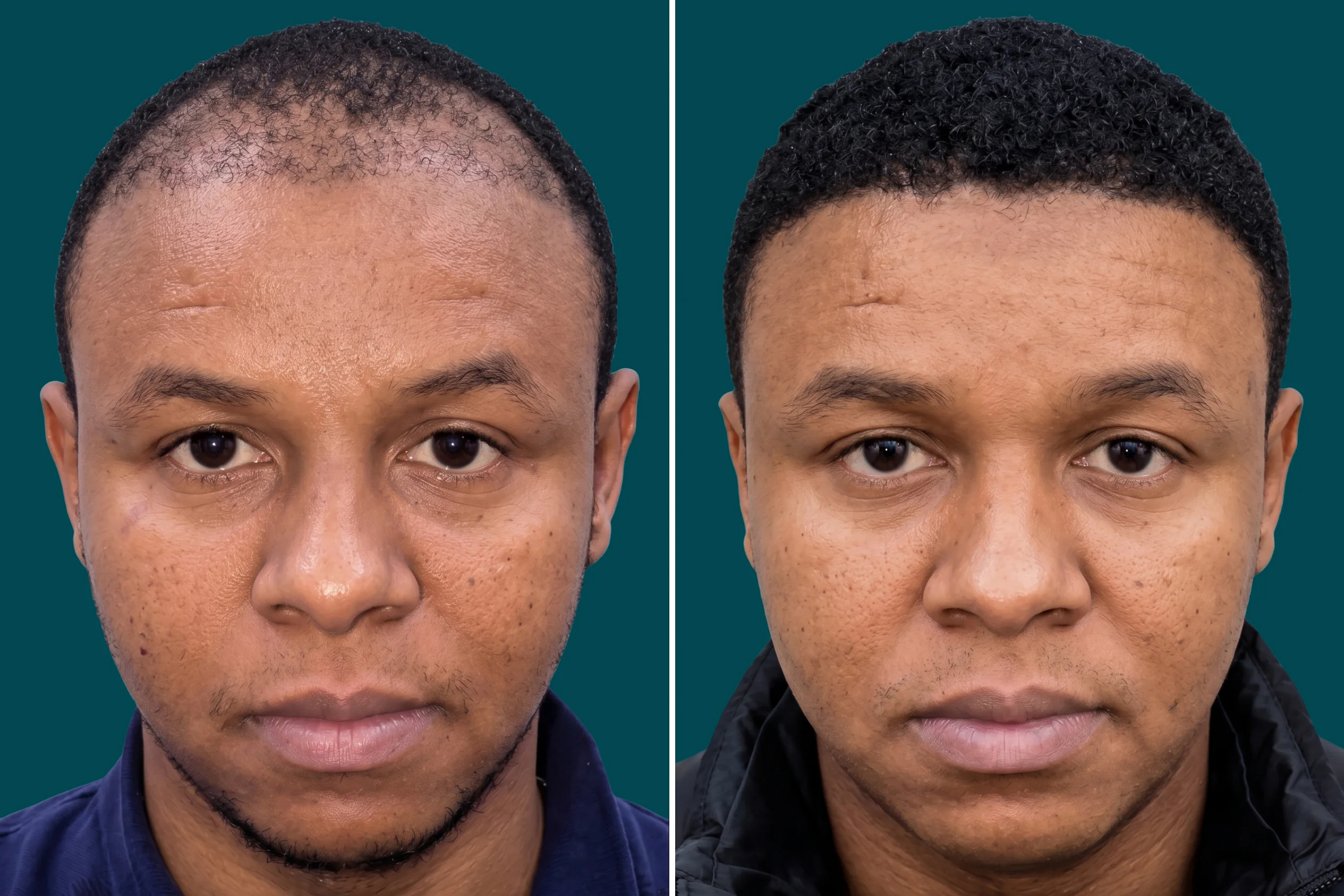 Afro Hair Transplant