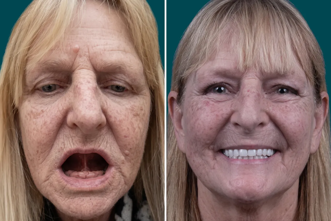 Dental Implants-All on 4 2