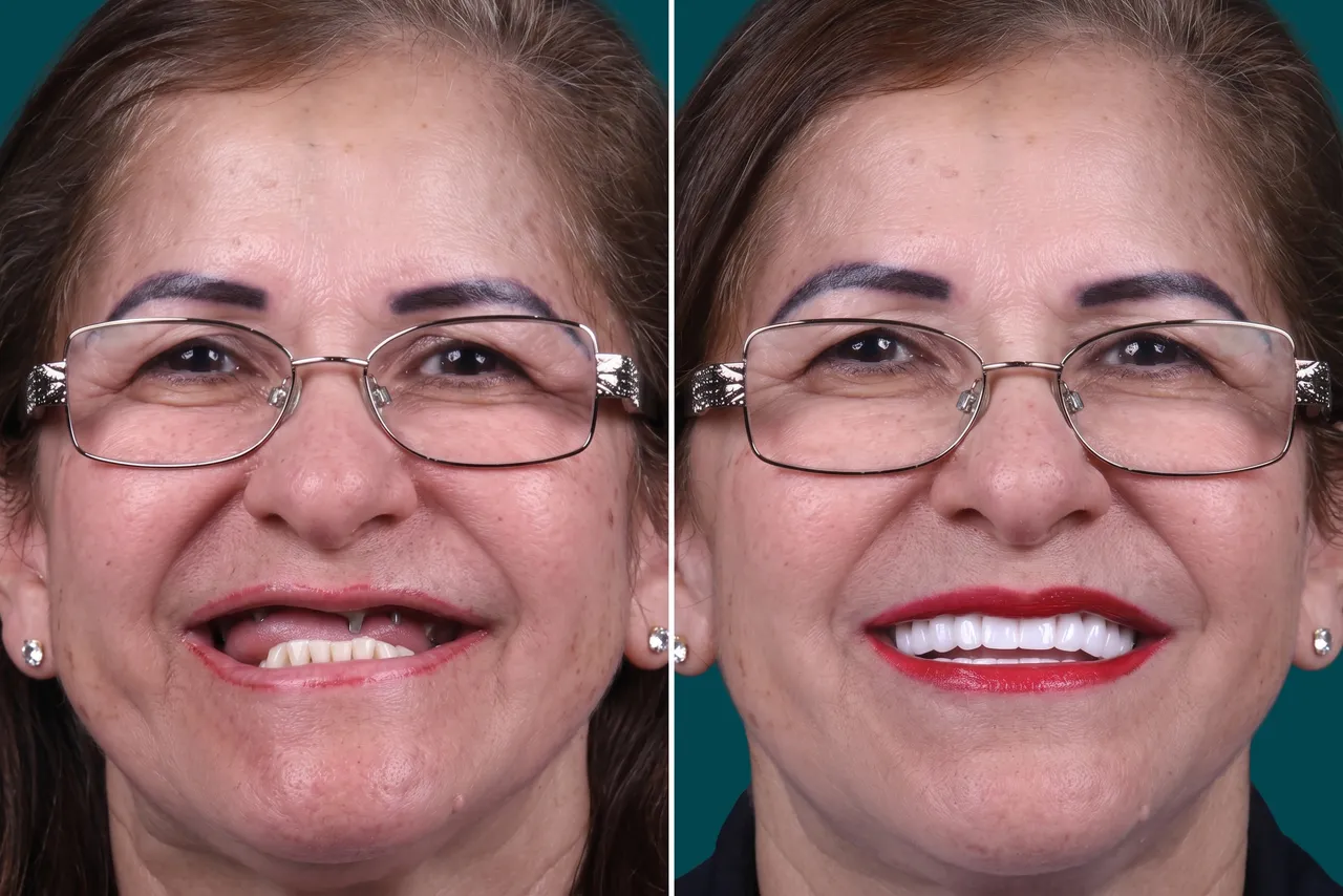 Dental Implants-All on 4 3