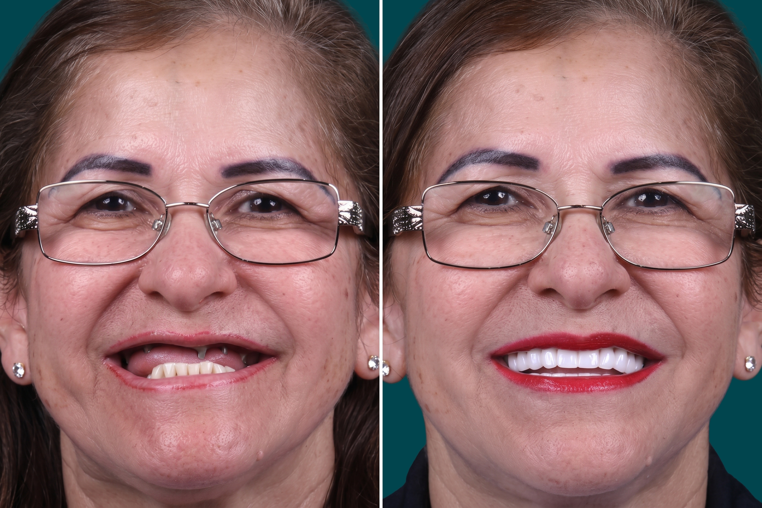 Dental Implants-All on 4 3