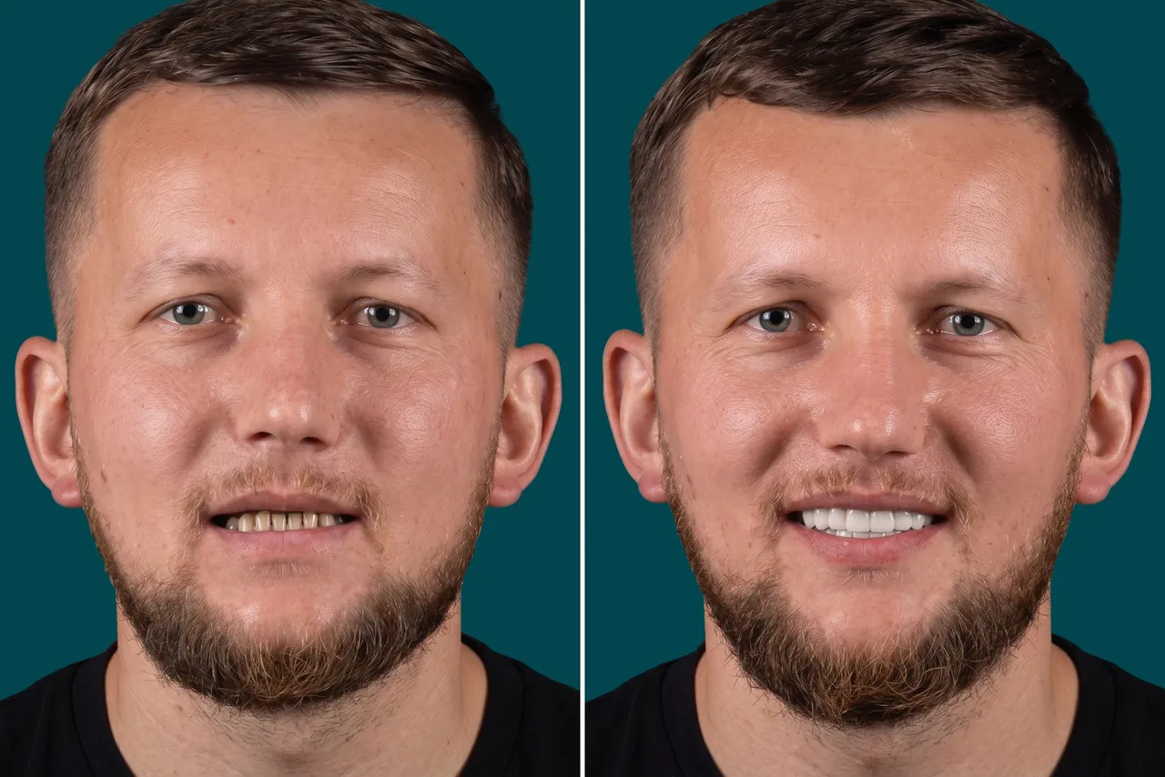 Dental Implants-All on 4 4