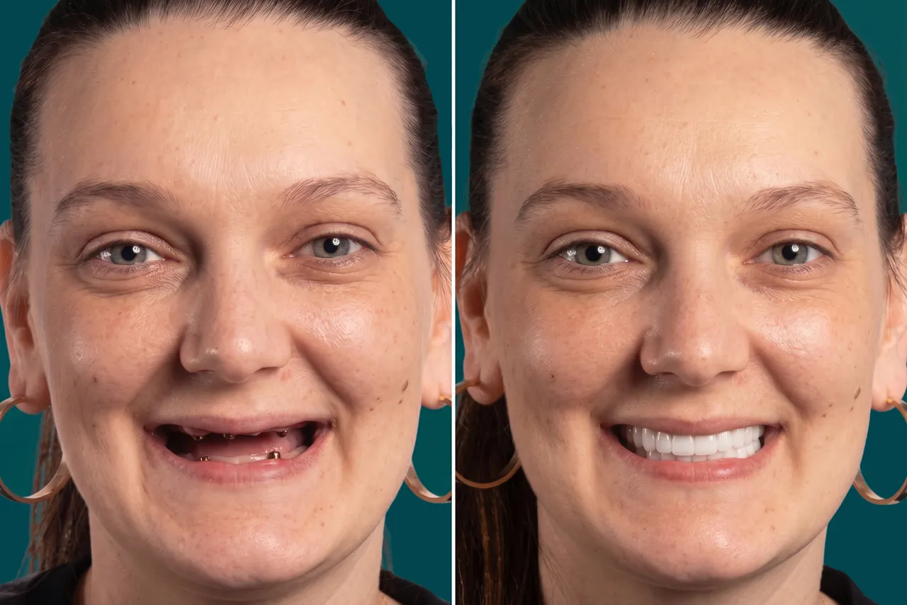 Dental Implants-All on 4 5