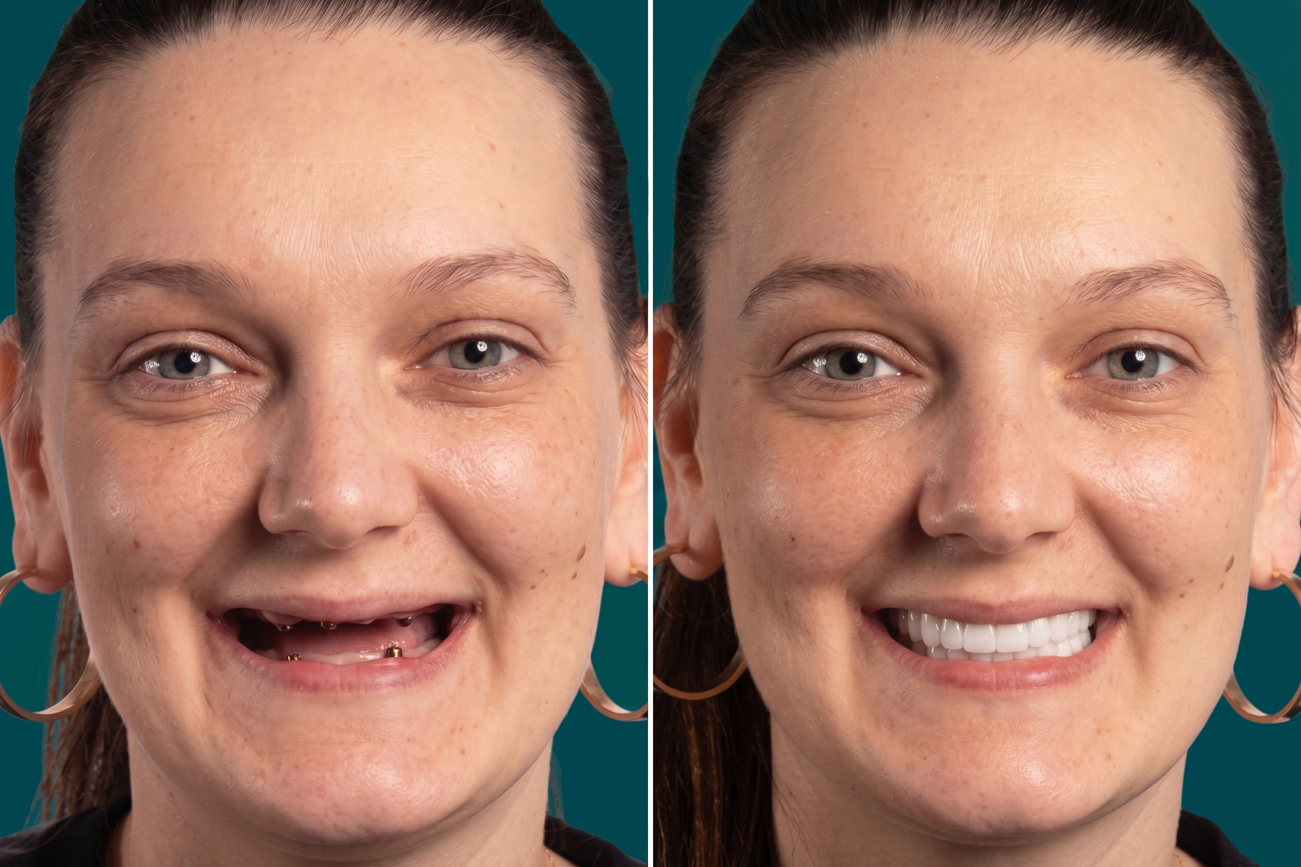 Dental Implants-All on 4 5