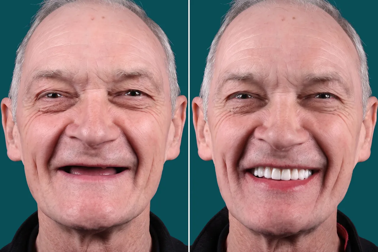Dental Implants-All On 6 1