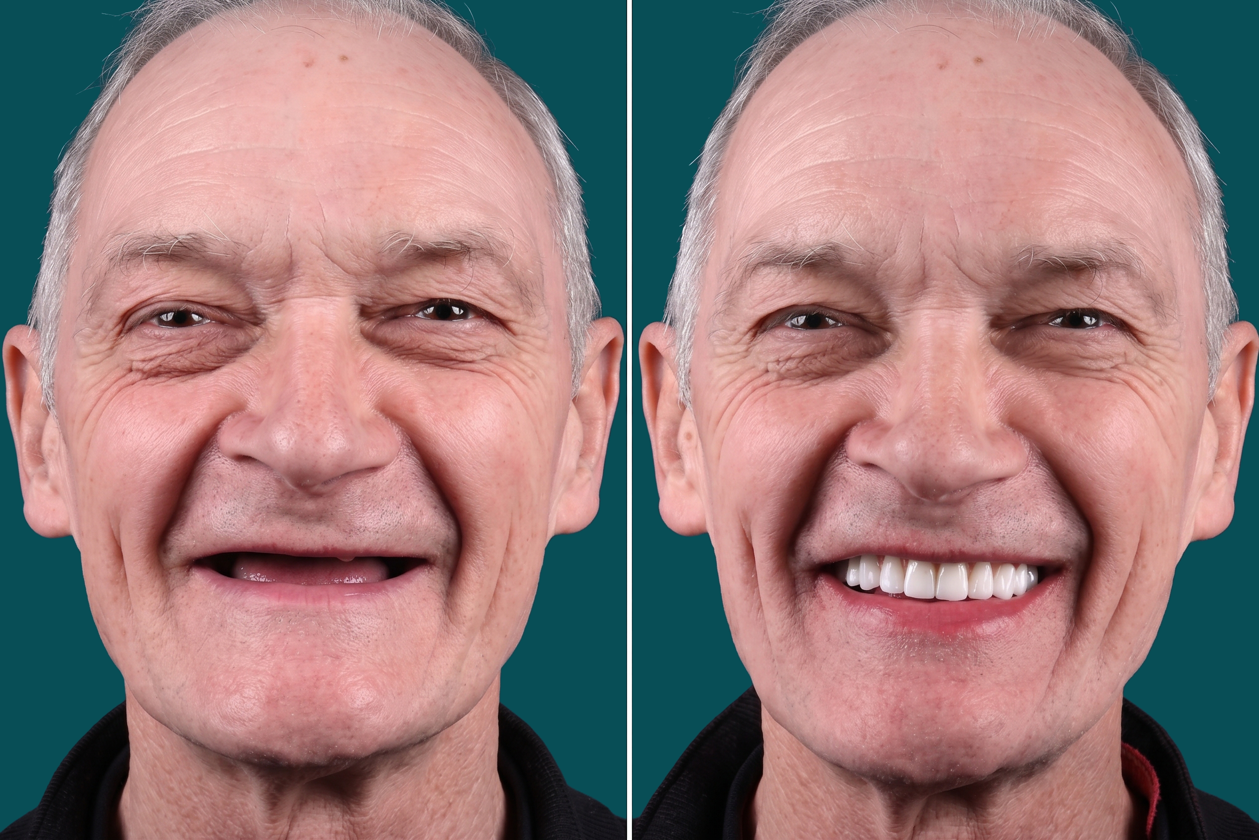 Dental Implants-All On 6 1
