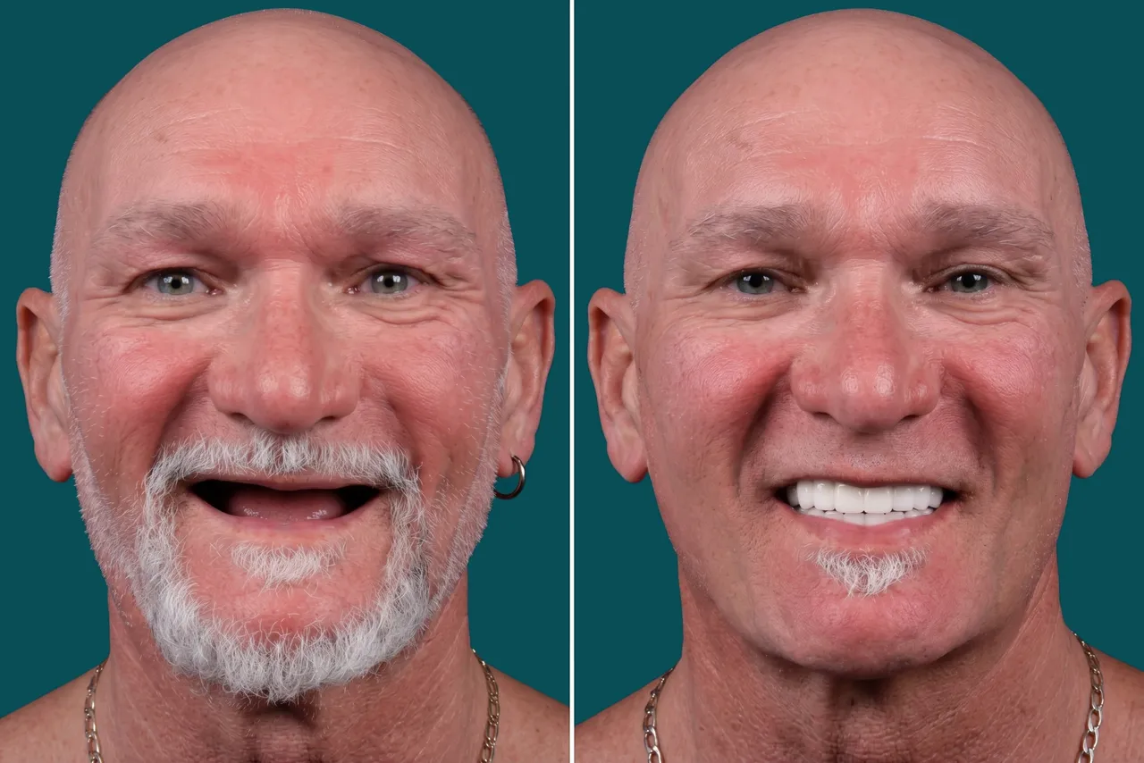 Dental Implants- All On 6 2
