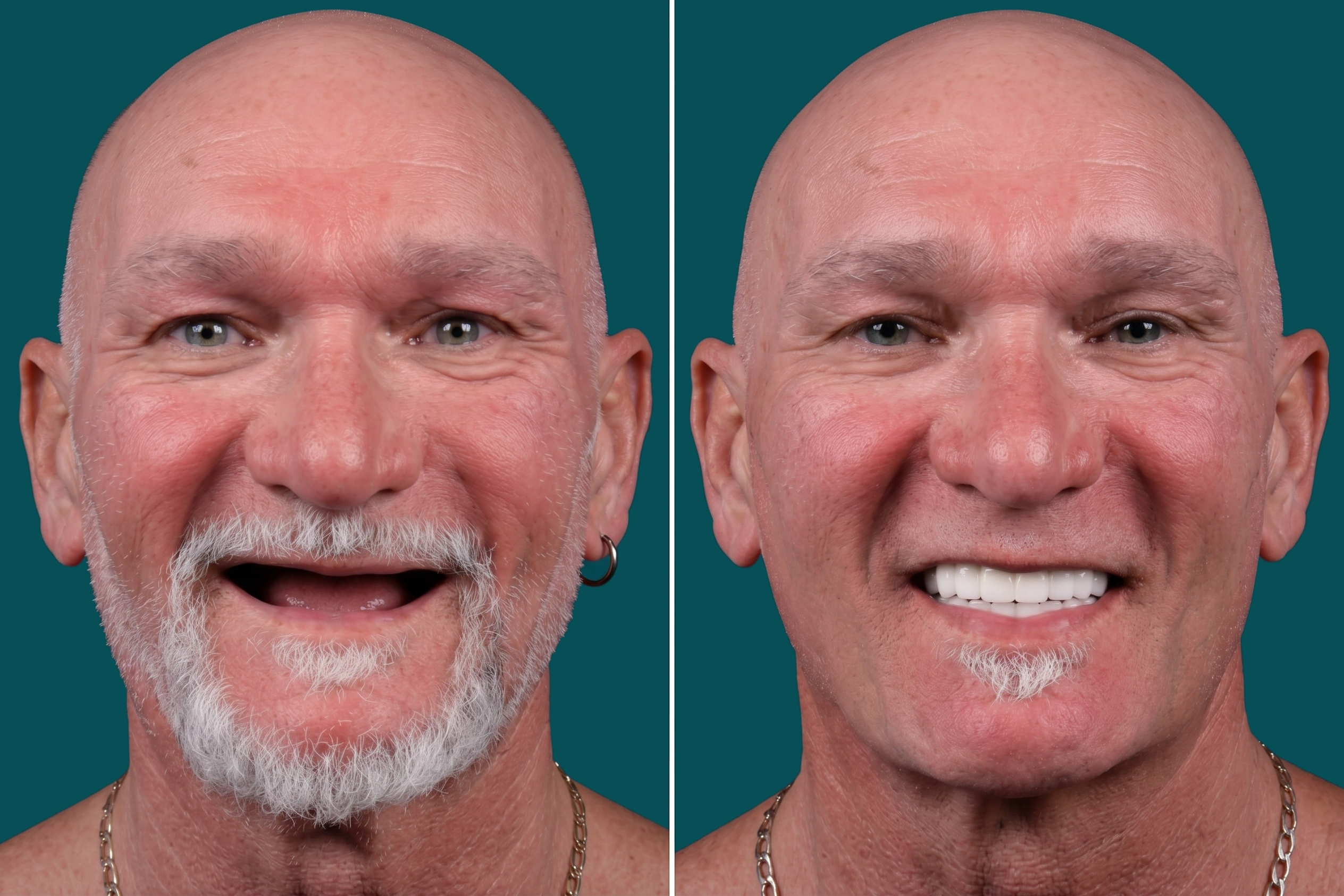 Dental Implants- All On 6 2