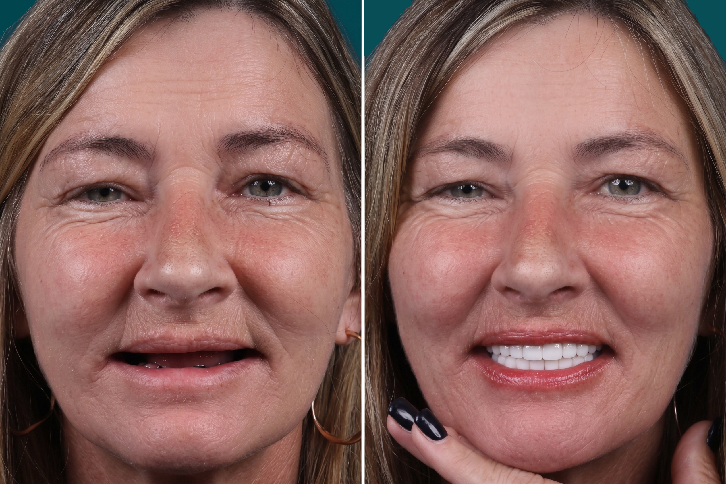 Dental Implants-All On 6