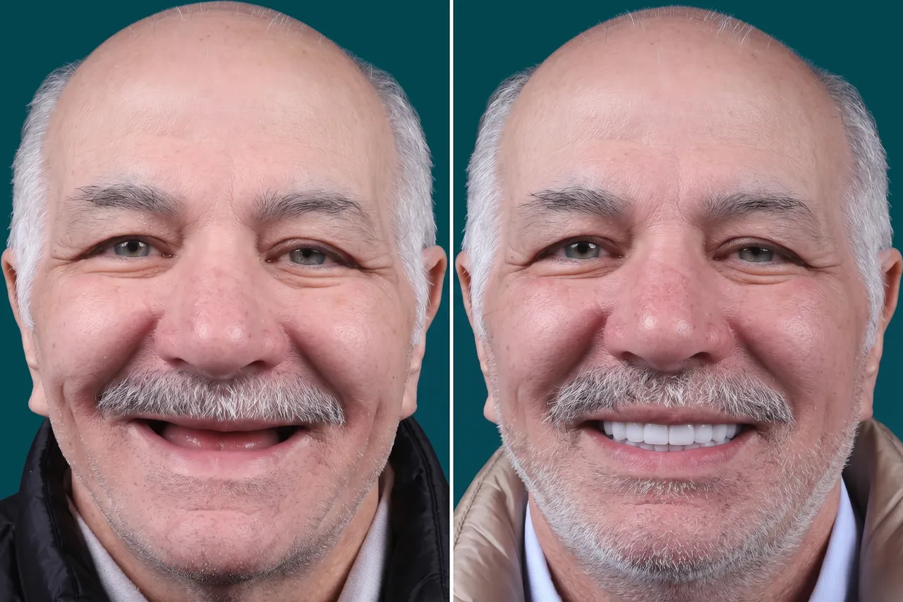 Dental Implants-All-on-6 4