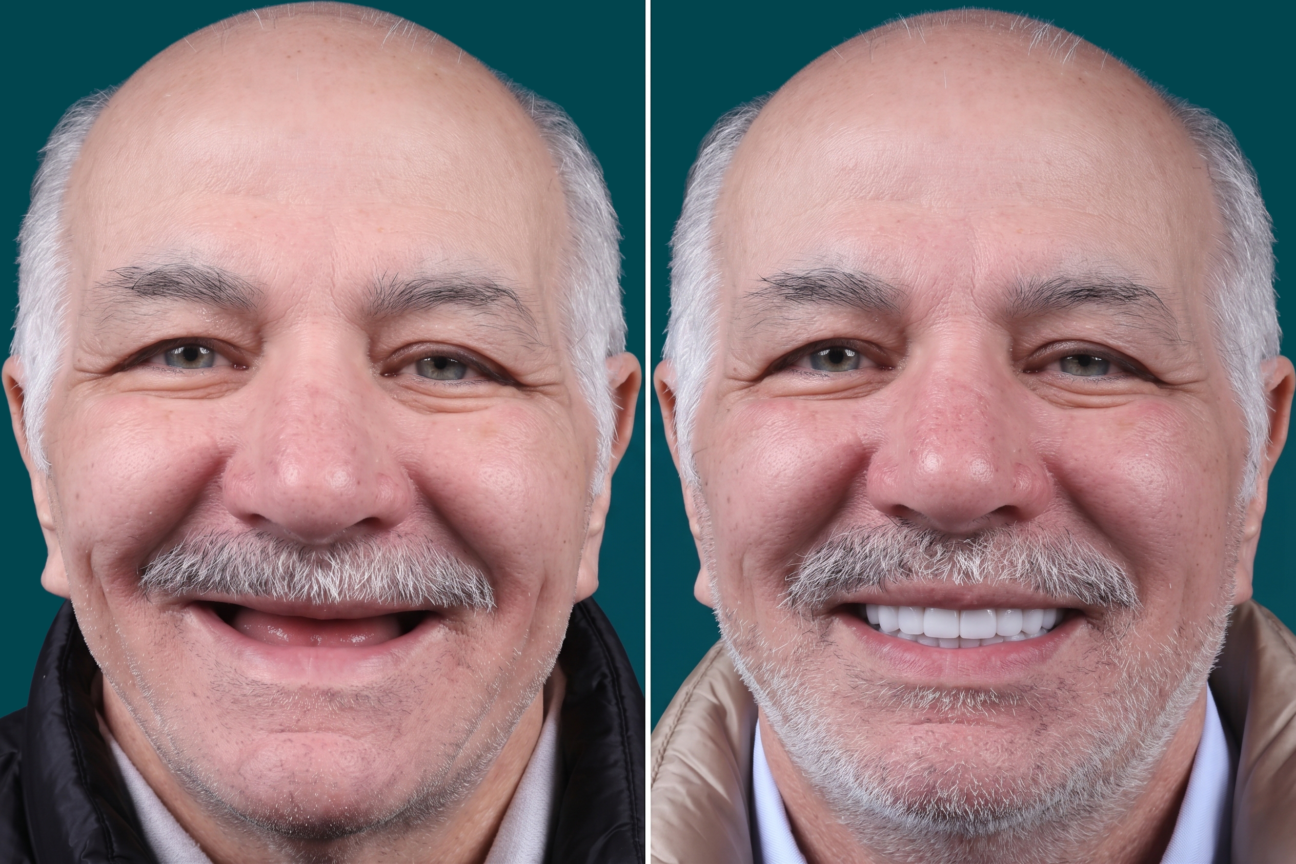  Dental Implants-All-on-6 4