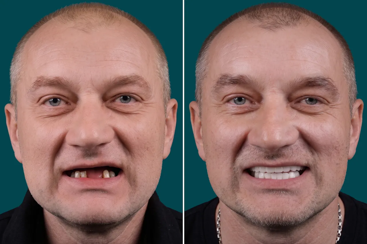  Dental Implants-All-on-6 5