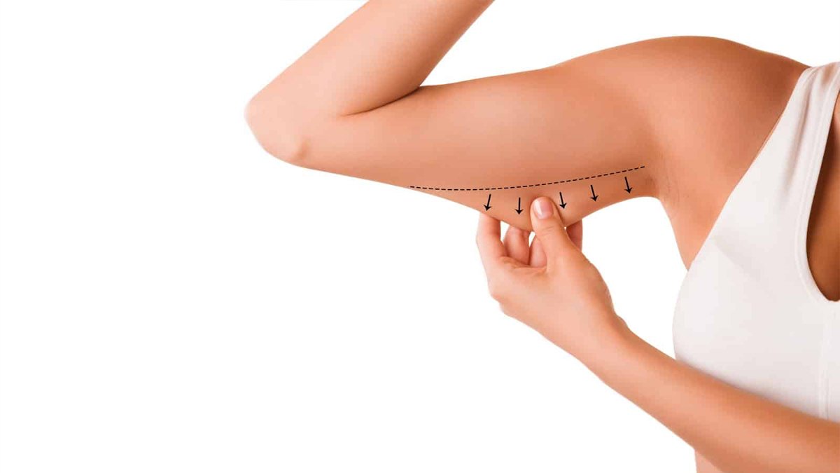 Arm Liposuction in turkey