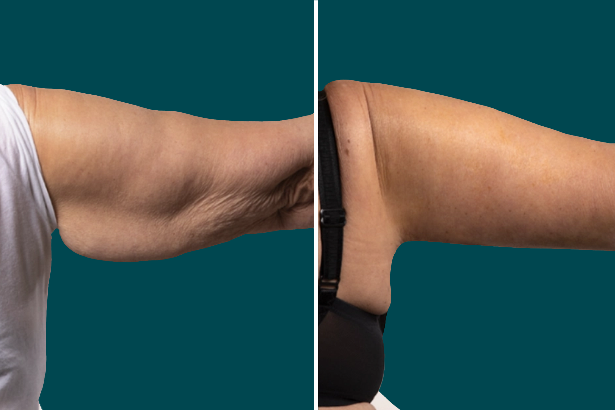 Arm Liposuction Before After In Turkey 1