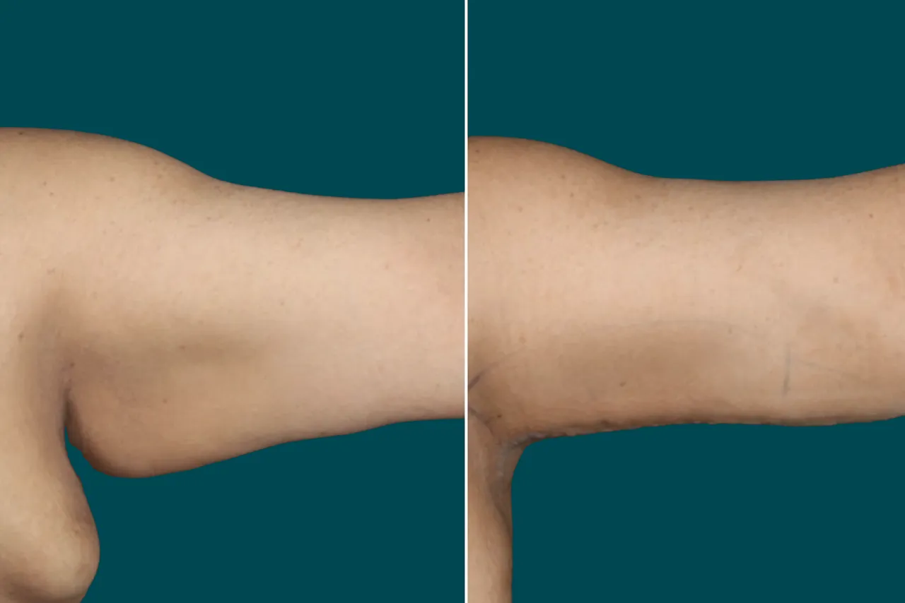 Arm Liposuction Before After In Turkey 2