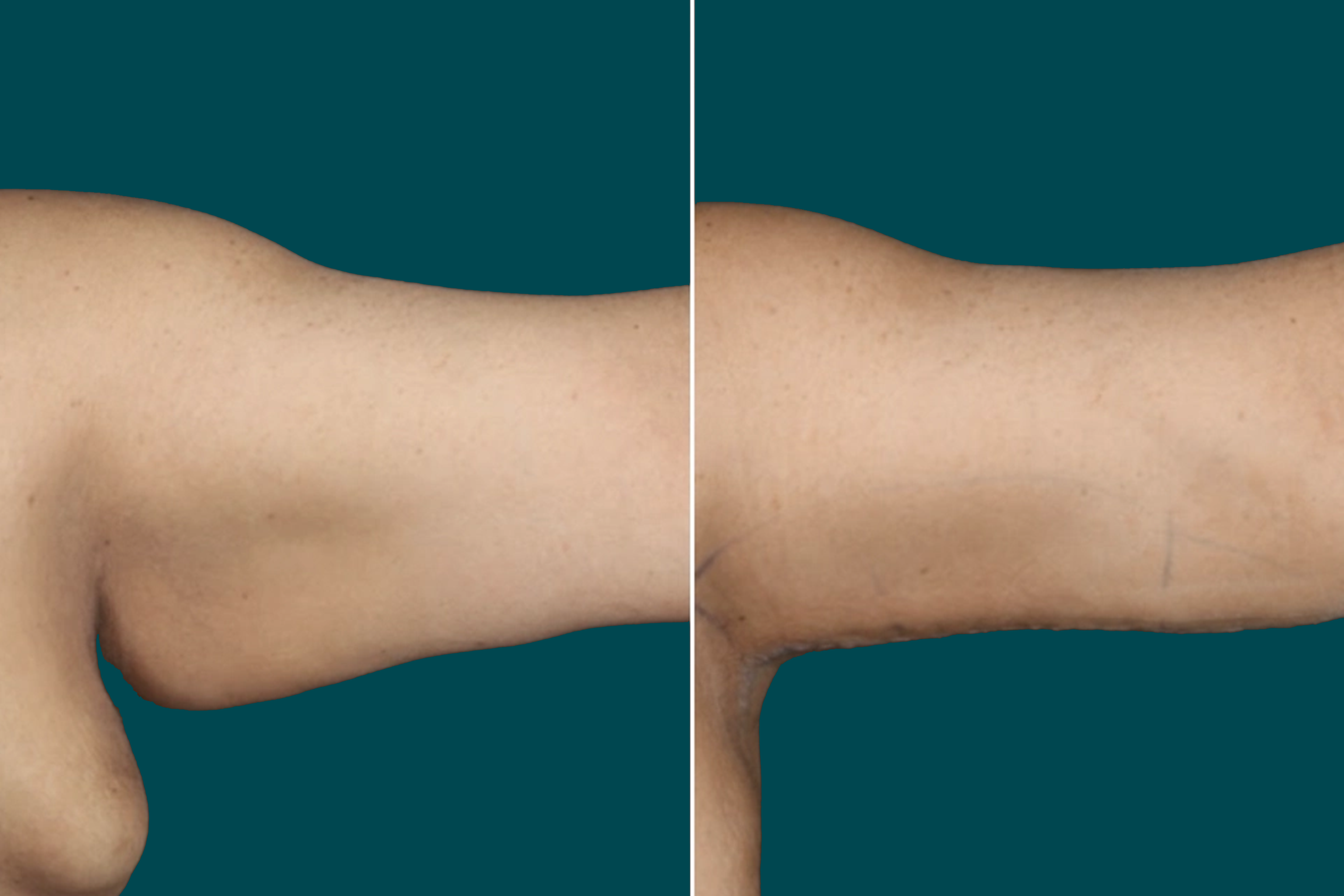 Arm Liposuction Before After In Turkey 2