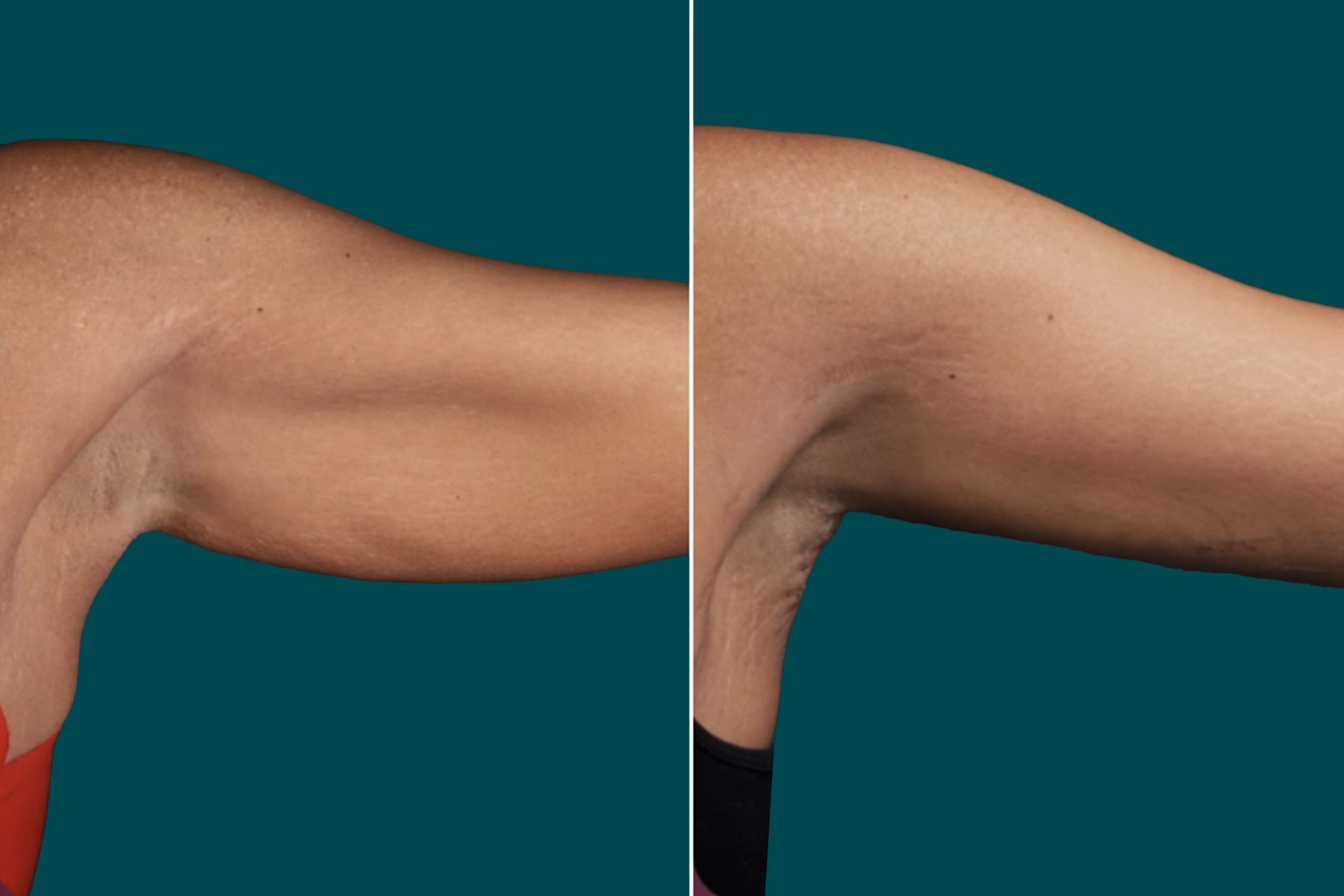 Arm Liposuction Before After In Turkey 3