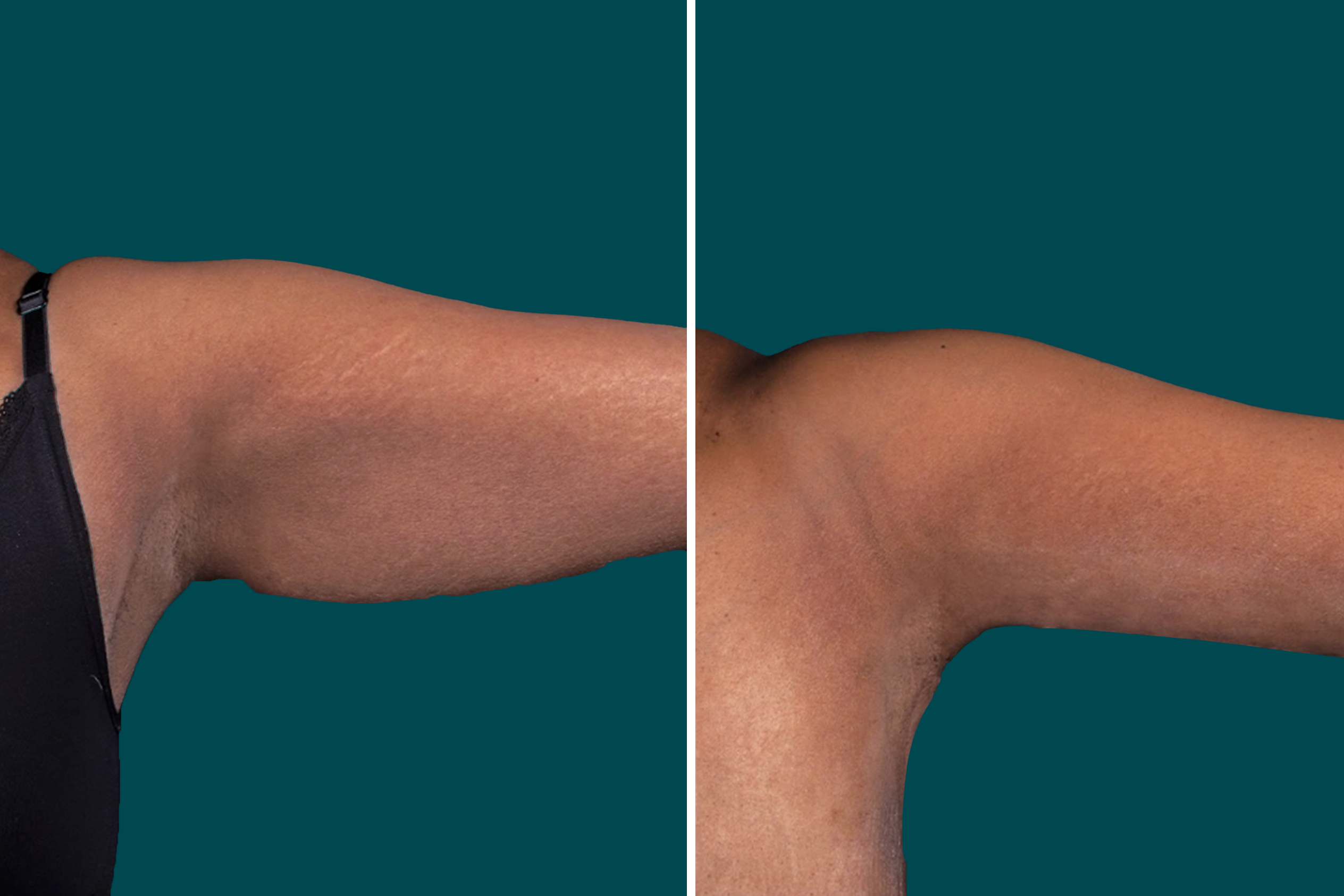 Arm Liposuction Before After In Turkey 4