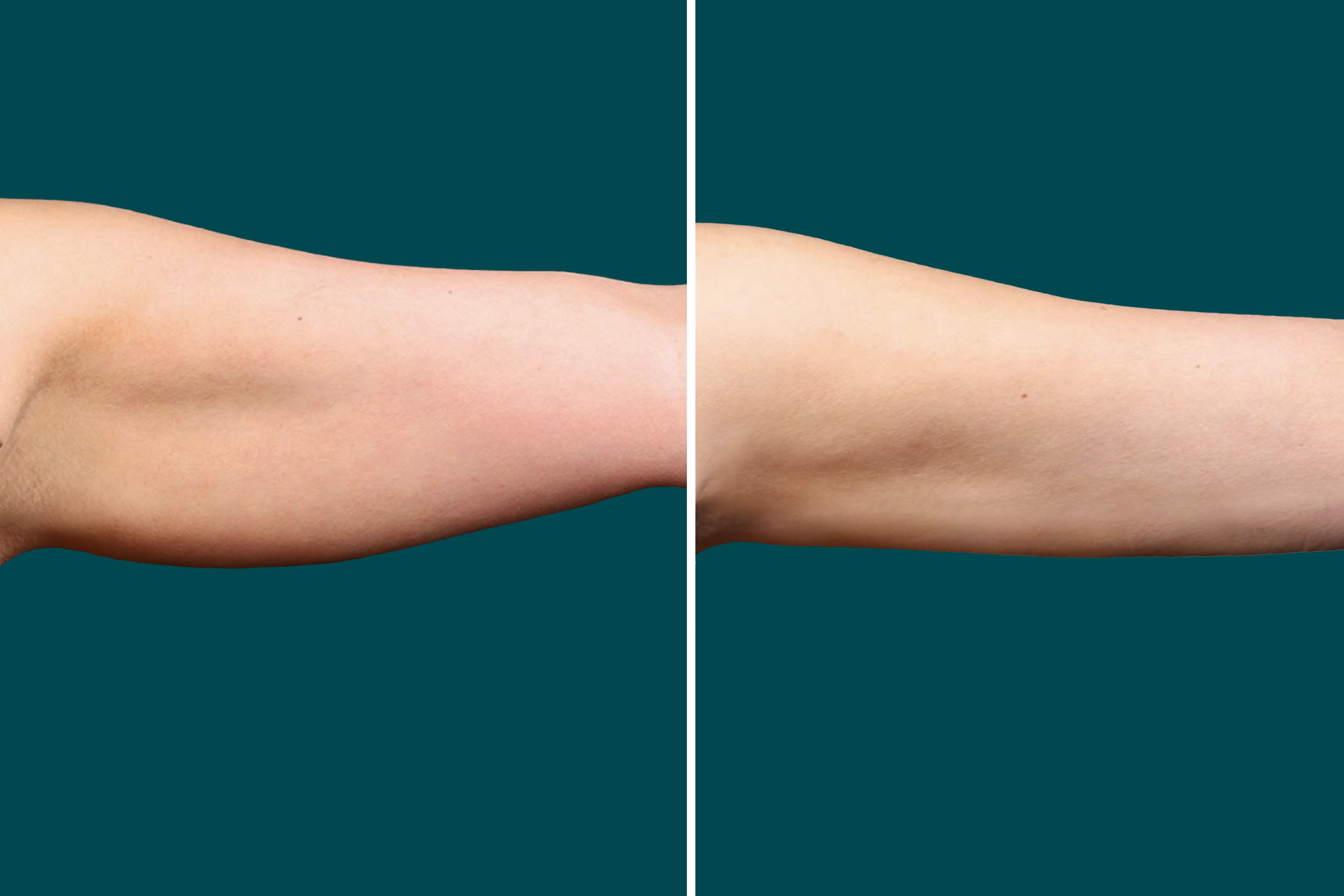 Arm Liposuction Before After In Turkey 5