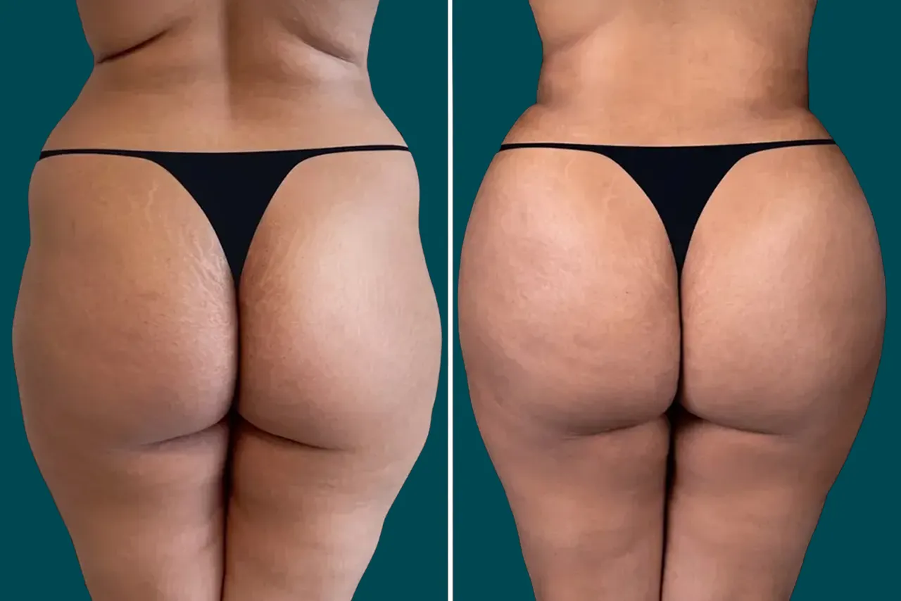 Brazilian Butt Lift - BBL 1