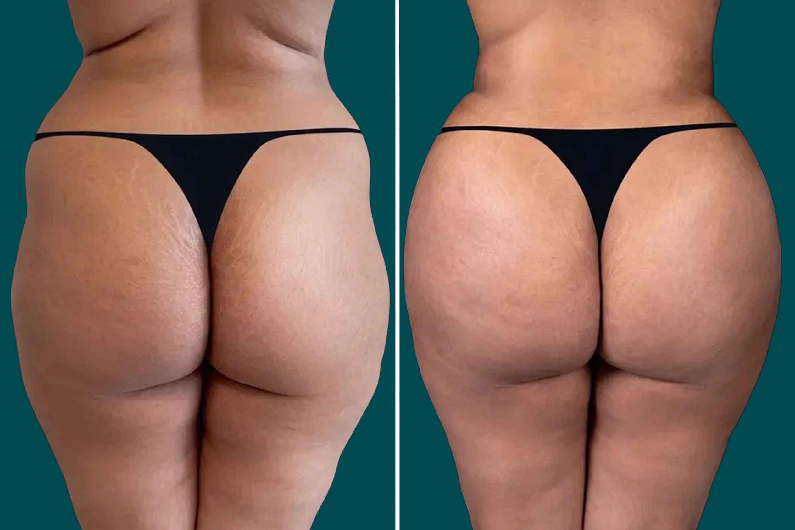 Brazilian Butt Lift - BBL 1